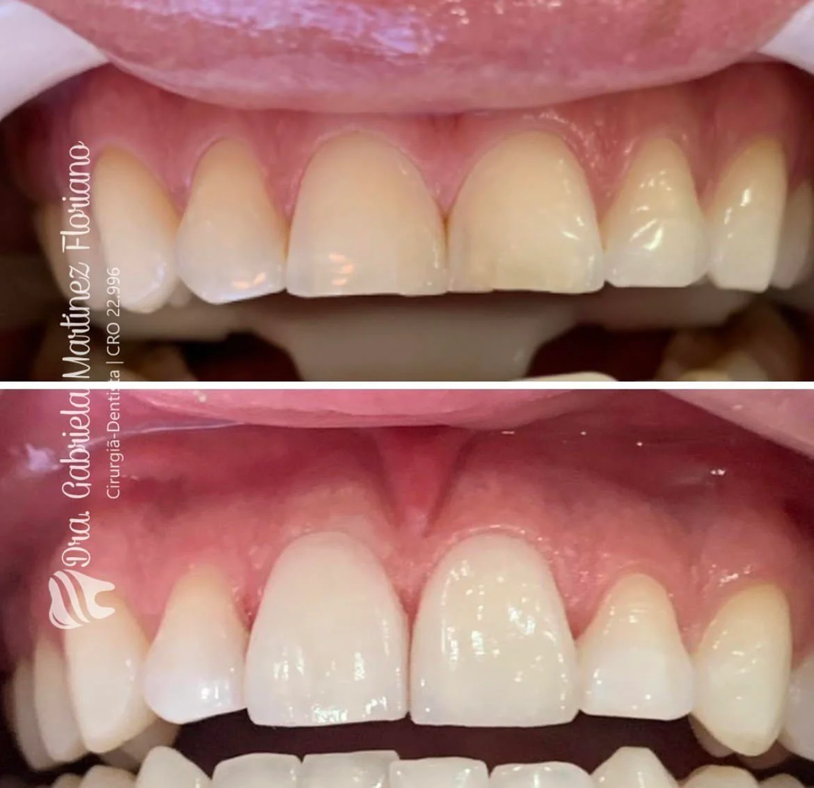 Caso clínico — Lentes de contato dental