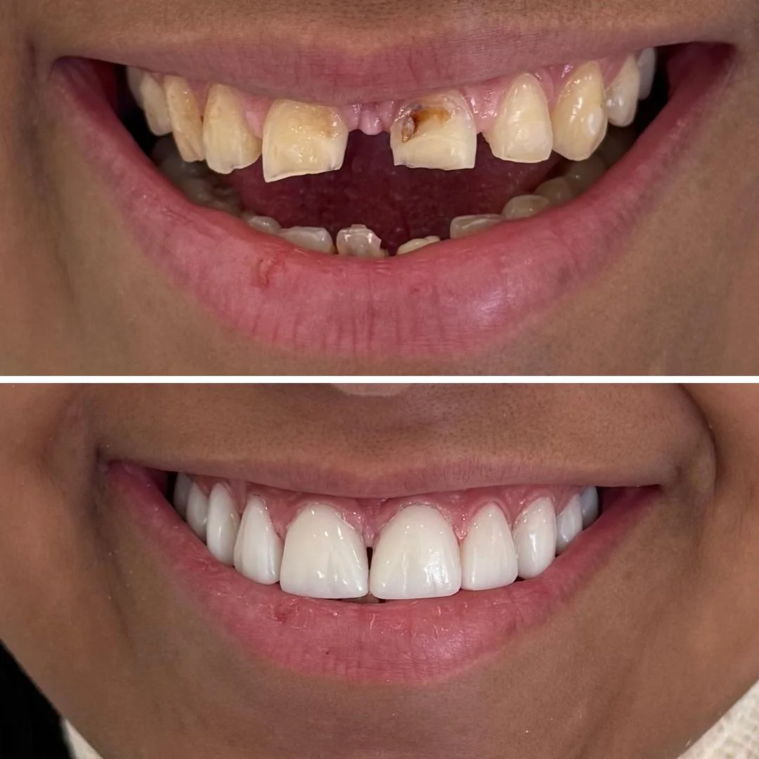 Caso clínico — Reabilitação com facetas