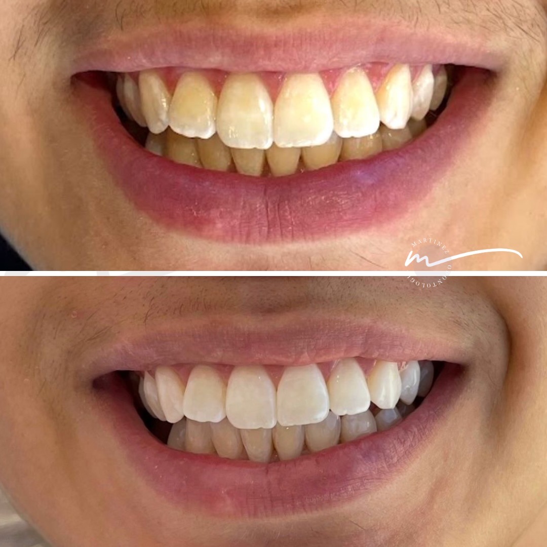 Caso clínico — Clareamento dental