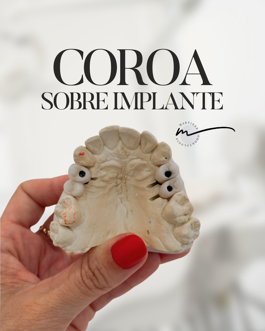 Caso clínico — Coroa sobre implante